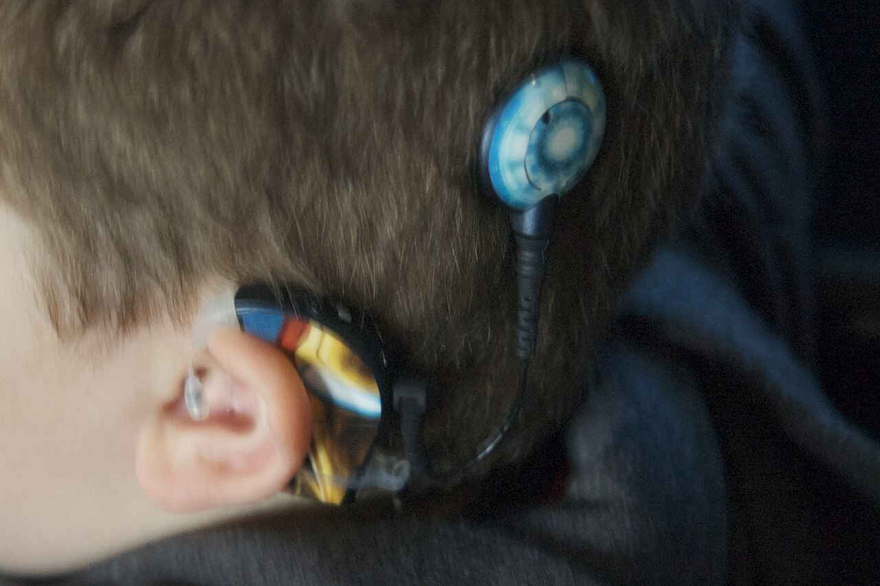 Ljudprocessor bakom örat och rund sändarspole med magnet på huvudet, sammankopplade med en kabel