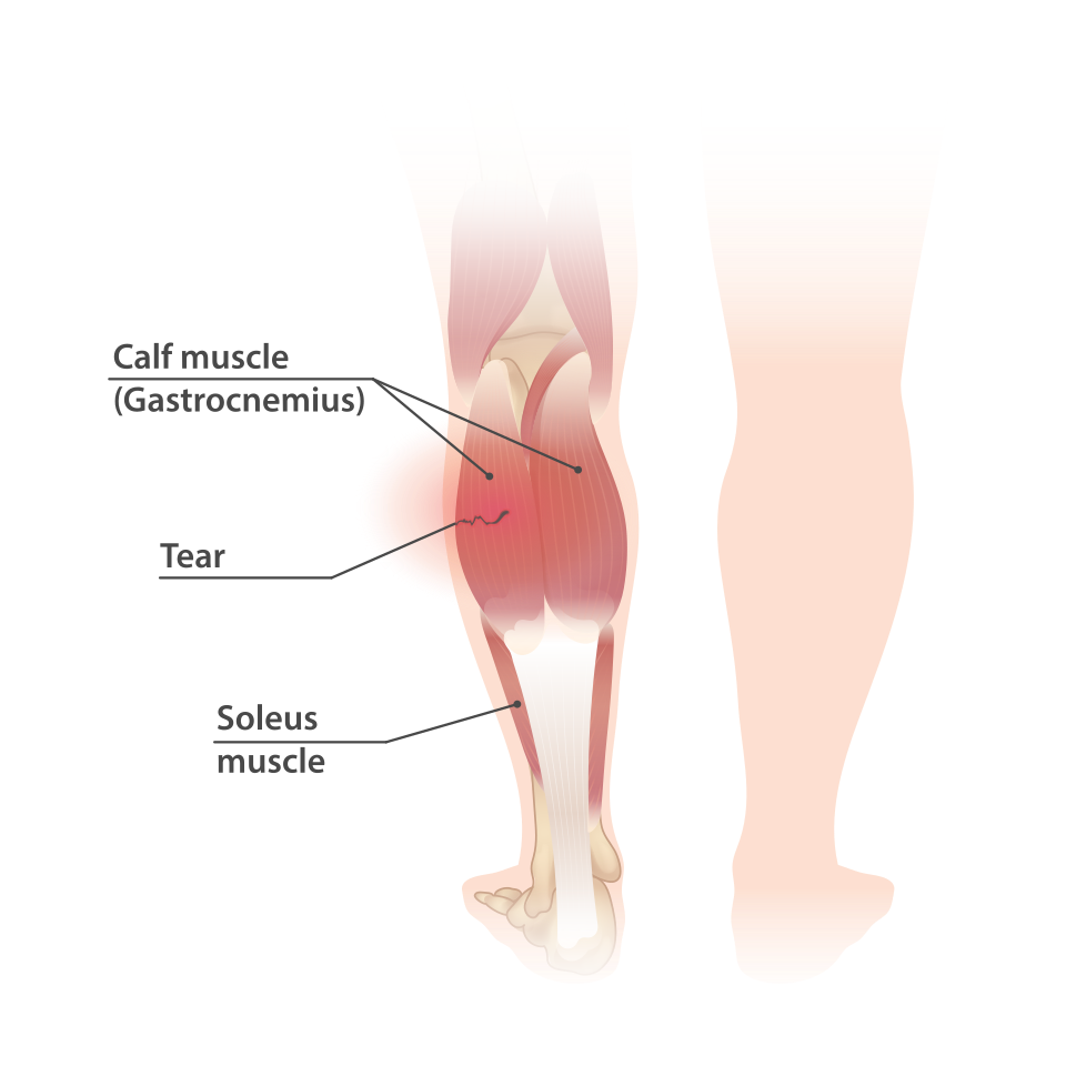 Illustration av vadens muskler bakifrån, med gastrocnemius ytterst och soleus under, och en markerad bristning i muskeln