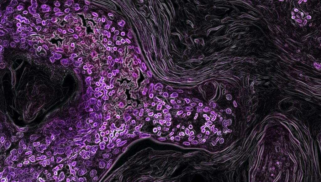 jump-in-cancer-diagnoses-at-65-implies-patients-wait-for-medicare