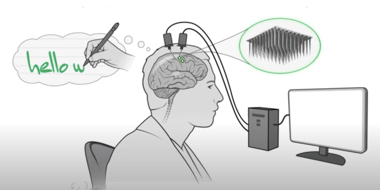 neural-implant-lets-paralyzed-person-type-by-imagining-writing-[90wpm]