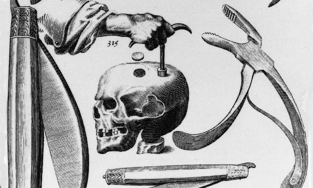 a-hole-in-the-head:-a-history-of-trepanation