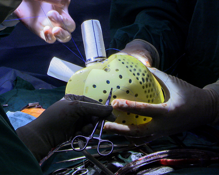 new-generation-artificial-heart-implanted-in-patient-at-duke-–-first-in-us.