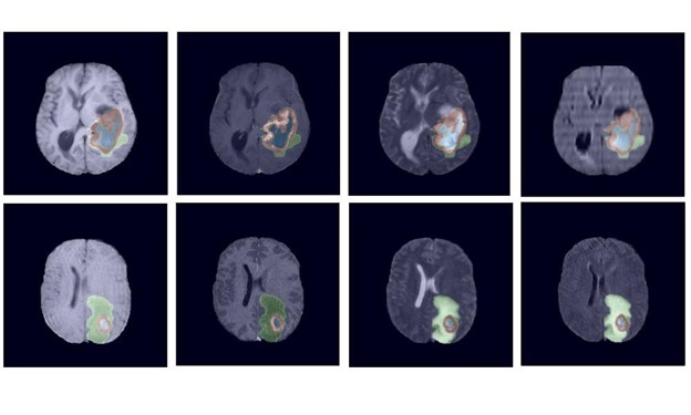 nvidia-scientists-take-top-spots-in-2021-brain-tumor-segmentation-challenge