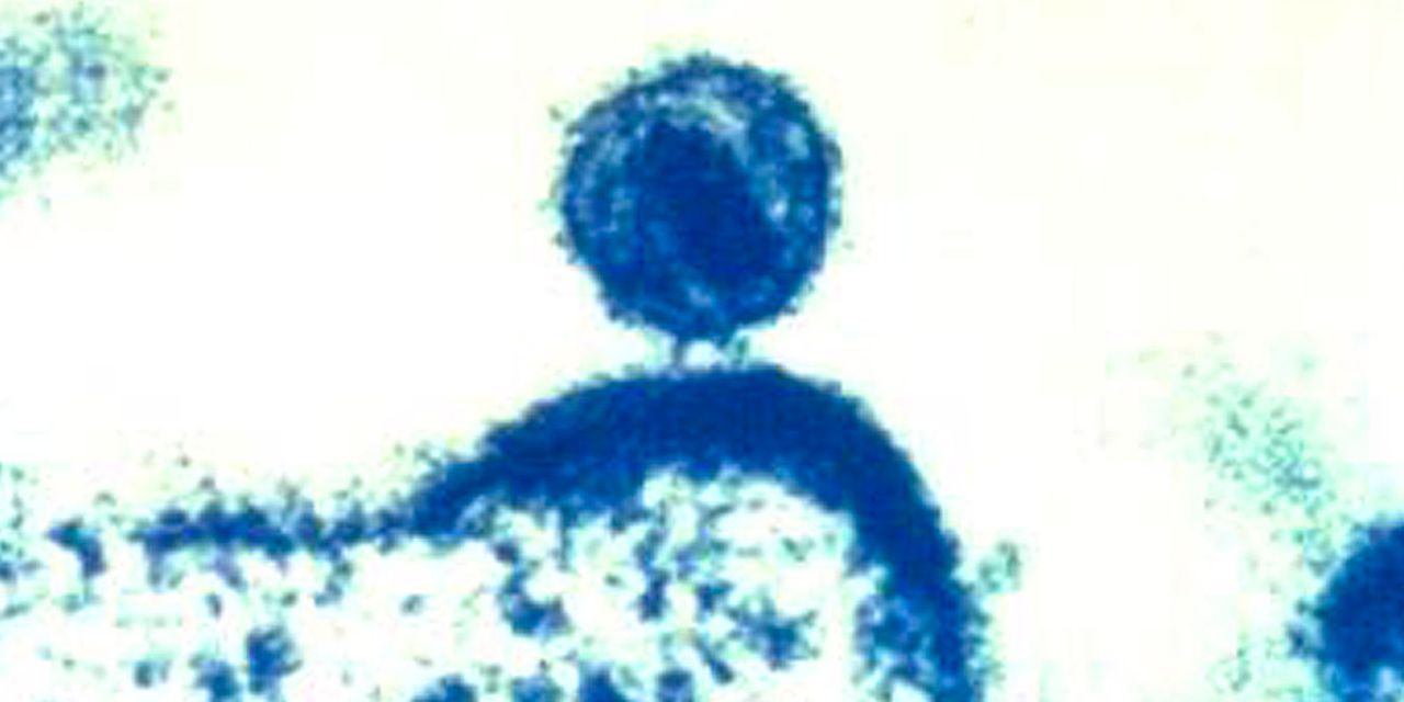 women-appears-cured-of-hiv-after-cord-blood-transplant