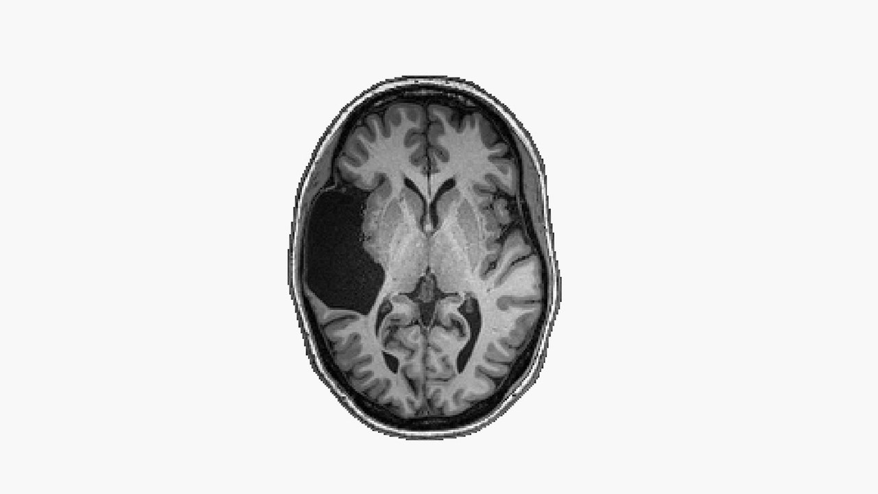 she-was-missing-a-chunk-of-her-brain.-it-didn’t-matter