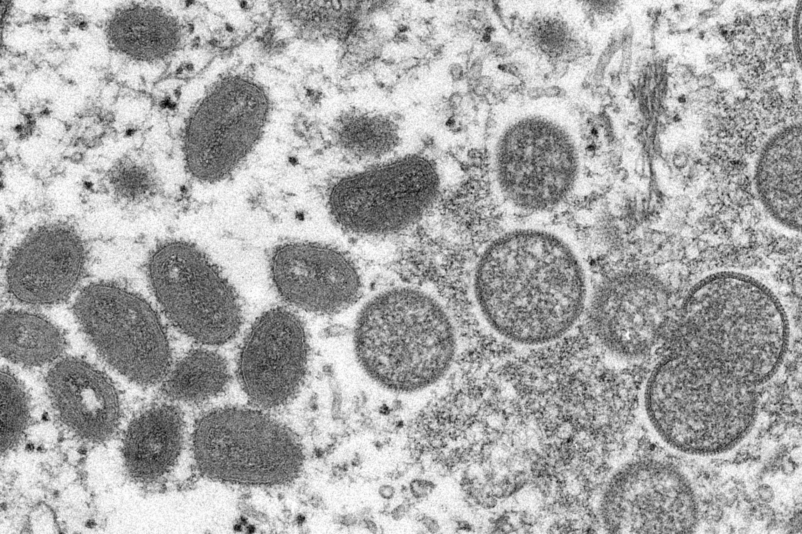 expert:-monkeypox-likely-spread-by-sex-at-2-raves-in-europe