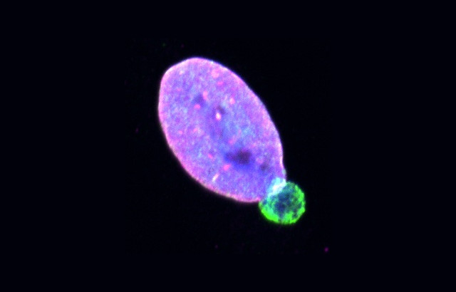 researchers-identify-protein-that-helps-skin-cancer-spread