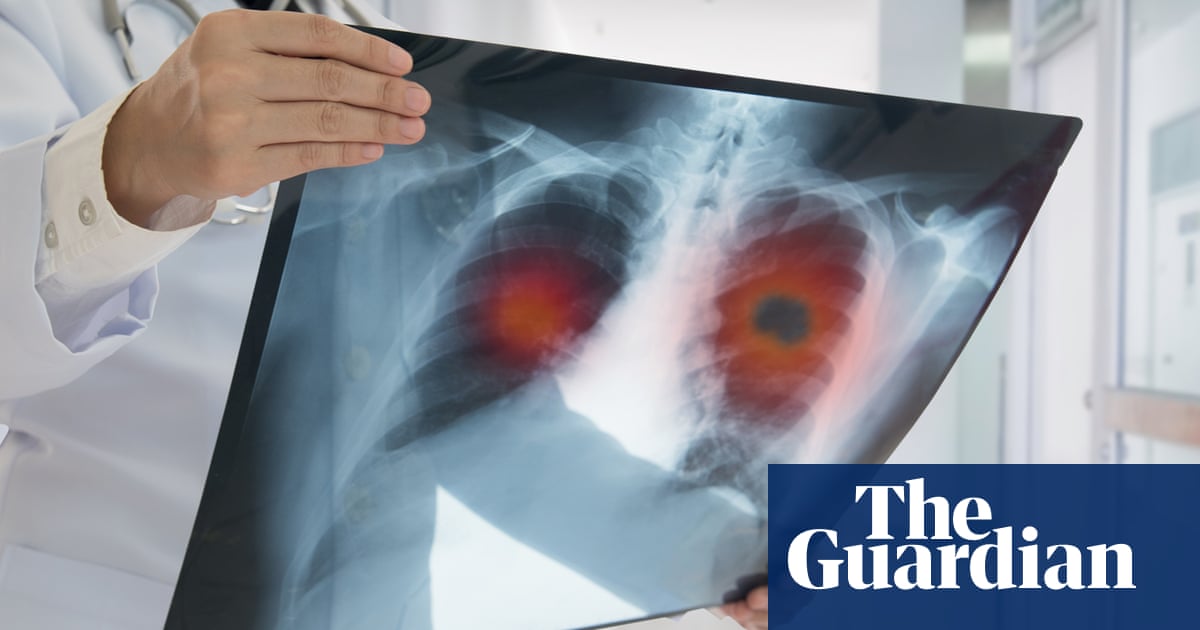lung-cancer-pill-cuts-risk-of-death-by-half