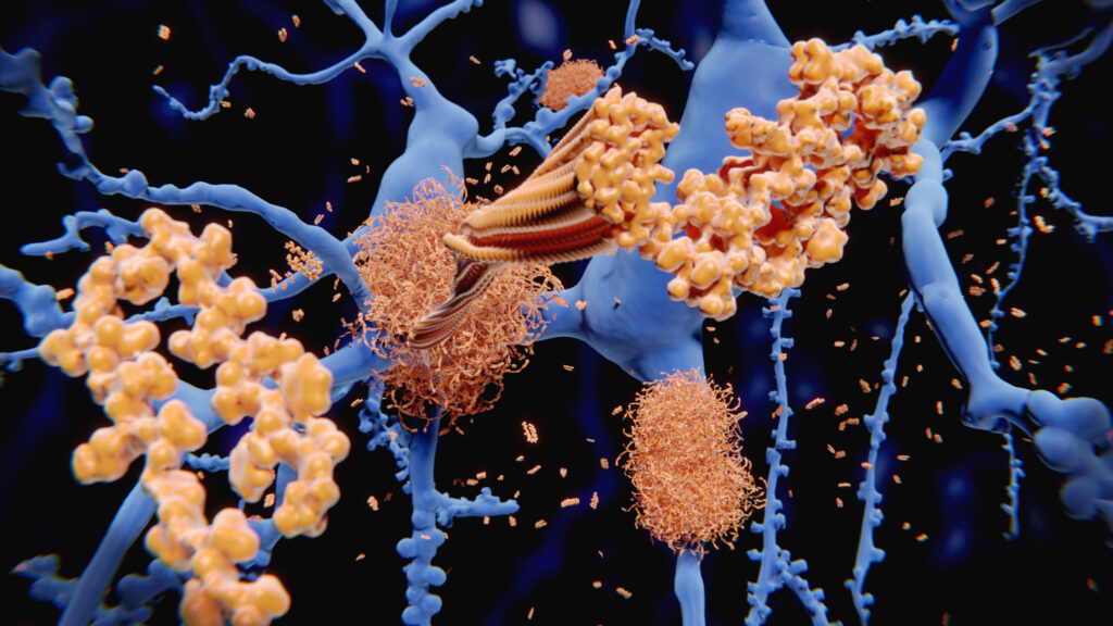 alzheimer’s-cases-tied-to-no-longer-used-medical-procedure