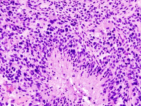 researchers-develop-treatment-that-can-kill-glioblastoma-cells-in-brain-pathway