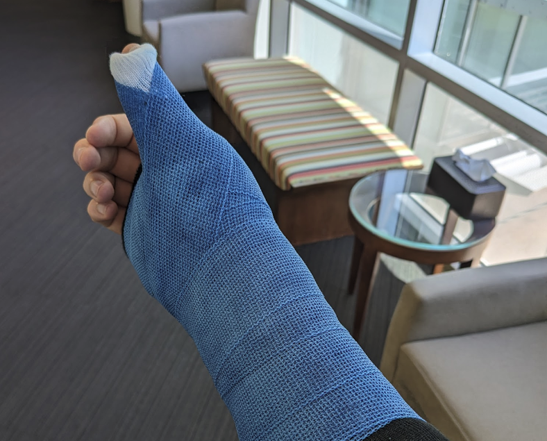 breaking-my-hand-forced-me-to-write-all-my-code-with-ai-for-2-months