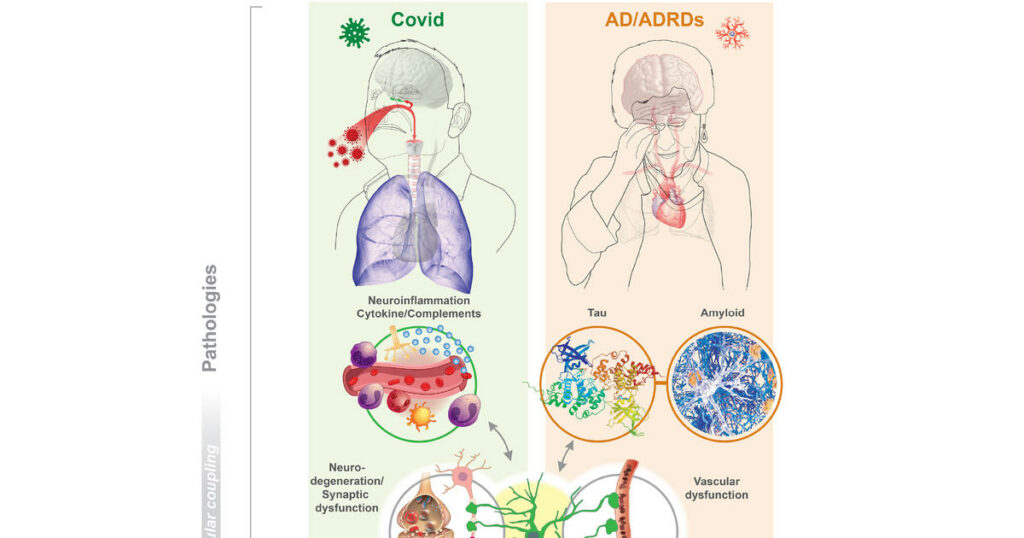 uk-researchers-find-alzheimer’s-like-brain-changes-in-long-covid-patients