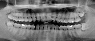 reports-of-the-death-of-dental-cavities-are-greatly-exaggerated