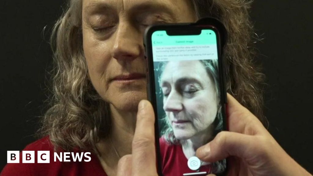 ai-used-for-skin-cancer-checks-at-london-hospital