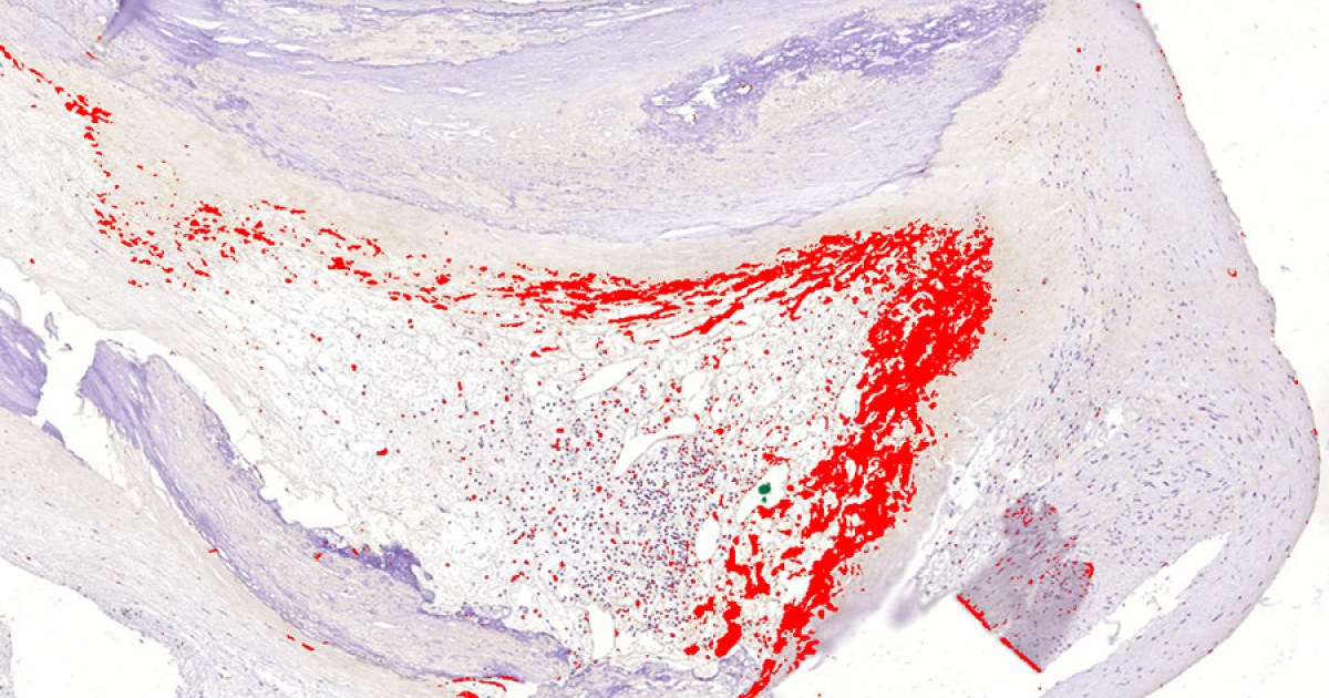 heart-attacks-may-be-triggered-by-bacteria