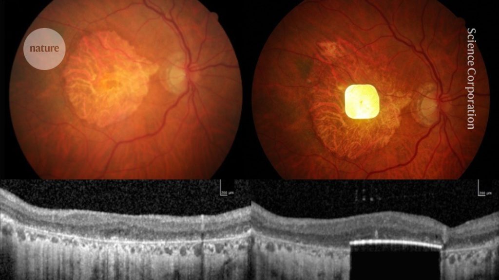people-with-blindness-can-read-again-after-retinal-implant